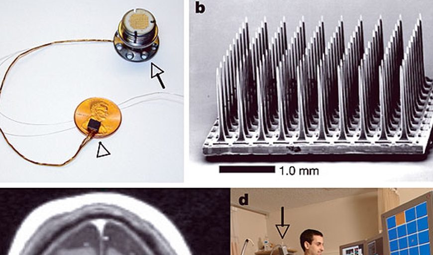 Un ensayo clínico confirma el potencial de los implantes de electrodos en ELA