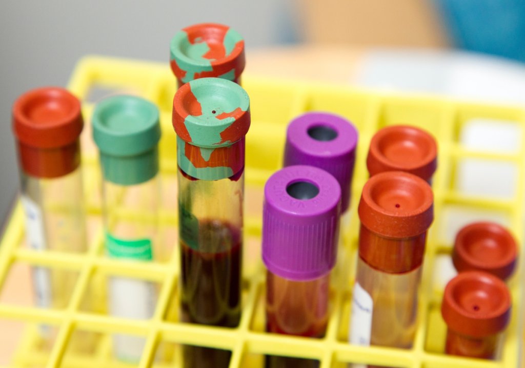 Este test de sangre detecta más de 50 tipos de cáncer y su localización