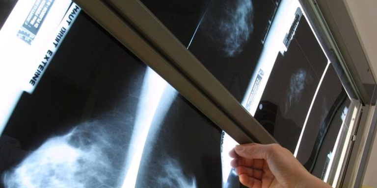 haber-tenido-un-falso-positivo-en-un-mamografia-eleva-el-riesgo-de-cancer-de-mama