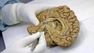 un-analisis-de-sangre-alerta-de-los-primeros-sintomas-diez-anos-antes-de-desembocar-en-alzheimer